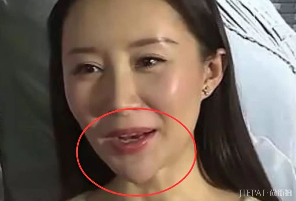 戚薇下巴动刀上百次照样美,为何郑爽整了一次就成了开瓶器