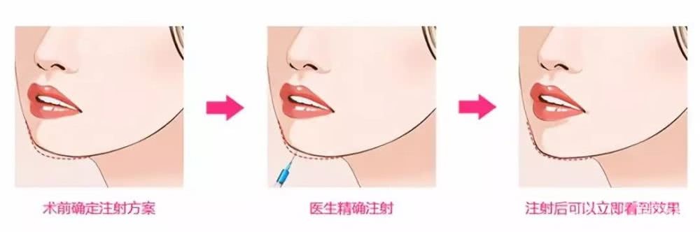 戚薇下巴动刀上百次照样美,为何郑爽整了一次就成了开瓶器
