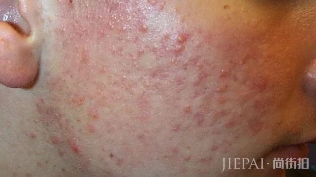 这里有种温和的祛痘方法,进来看看吧!