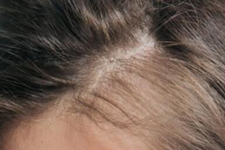 最全护发百科!女人最愁的脱发问题，想要改善就得这样做