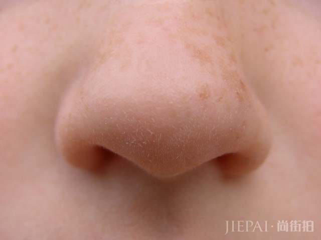 内分泌失调长痘痘怎么调理，几个消除痘痘小妙招