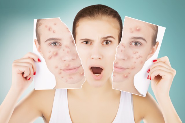 祛痘痘最有效的方法，5个方法真的有用，再也不担心长痘了