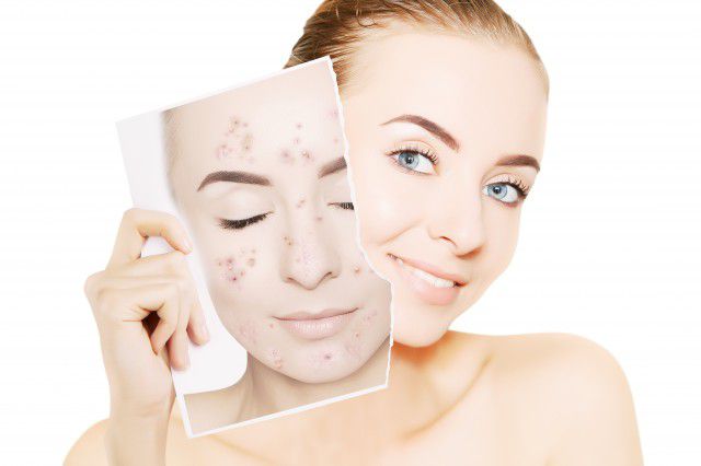 1576120434602574.jpeg 黑色痘印如何去除,6个妙招为你解决痘印烦恼