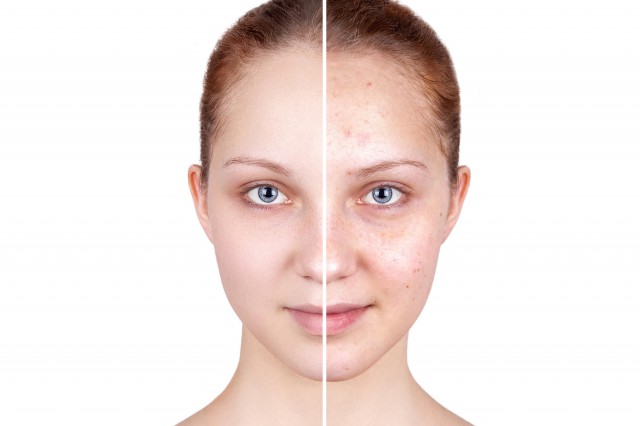 脸颊老长痘痘怎么办,7个方法调理祛除痘痘