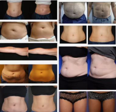 为什么“减肥王者”还是酷塑冷冻减脂?