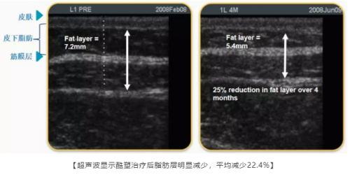 为什么“减肥王者”还是酷塑冷冻减脂？
