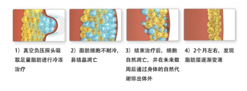 为什么“减肥王者”还是酷塑冷冻减脂？