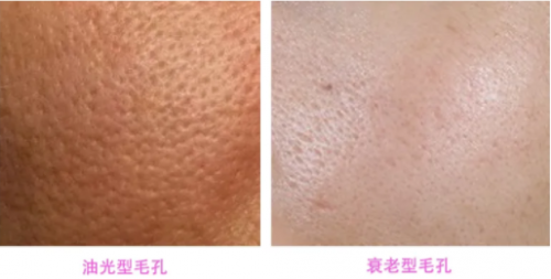 有了海菲秀＋黄金微针，毛孔粗大？不存在的！