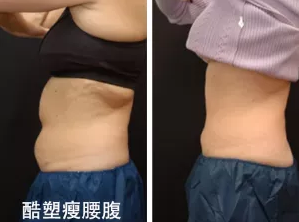 为什么“减肥王者”还是酷塑冷冻减脂？