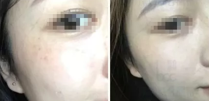 双皮秒开启肌肤新篇章，改变肌肤命运！