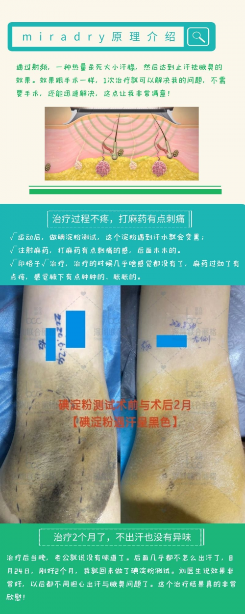 「真人测评」miradry清新微波止汗祛腋臭60天，运动后腋下超干爽！