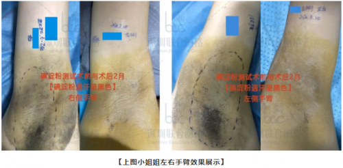 「真人测评」miradry清新微波止汗祛腋臭60天，运动后腋下超干爽！