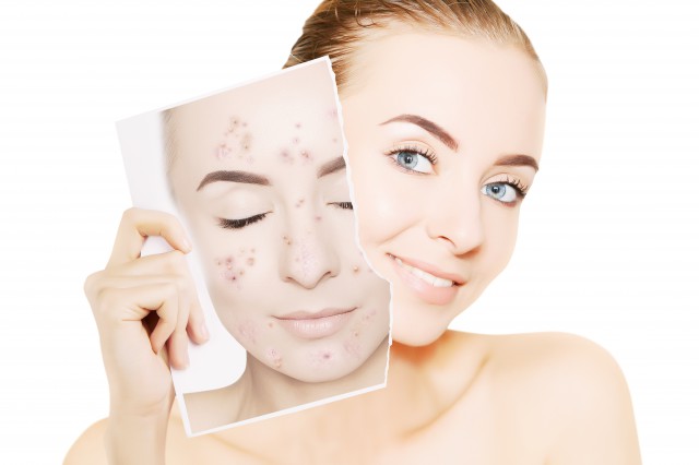 淡化痘印有效的方法 修复痘印的方法有哪些