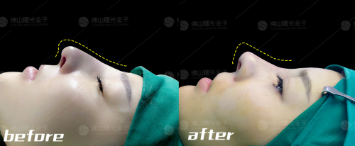 曙光金子隆鼻巨匠刘云忠:如果一辈子只坚持做好一件事,那就是鼻整形!