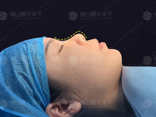 曙光金子隆鼻巨匠刘云忠:如果一辈子只坚持做好一件事,那就是鼻整形!