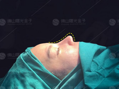 曙光金子隆鼻巨匠刘云忠:如果一辈子只坚持做好一件事,那就是鼻整形!