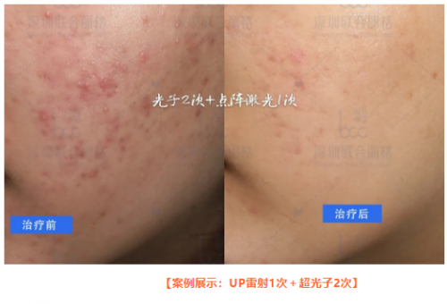 祛痘痘、痘印，平痘坑：UP雷射＋超光子，痘肌油皮的福音！