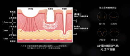 祛痘痘、痘印，平痘坑：UP雷射＋超光子，痘肌油皮的福音！
