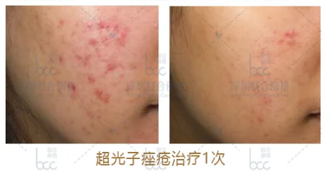 祛痘痘、痘印，平痘坑：UP雷射＋超光子，痘肌油皮的福音！