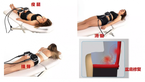 有了fotona星丽人“全能增肌王”，马甲线、蜜桃臀、小鸟腿都不是事！