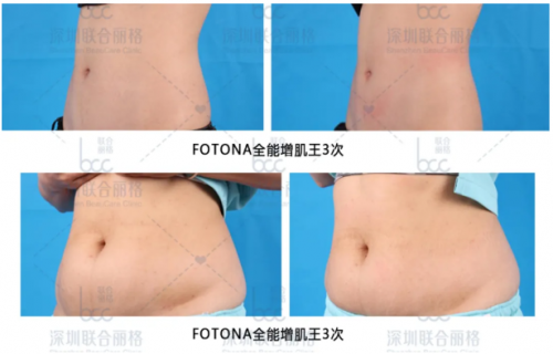 有了fotona星丽人“全能增肌王”，马甲线、蜜桃臀、小鸟腿都不是事！