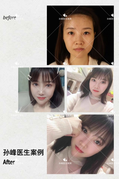 为什么孙峰医生的手术还需要排队预约?