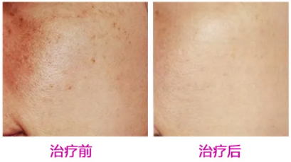 同属抗衰激光,fotona4d与5gmax怎么选?