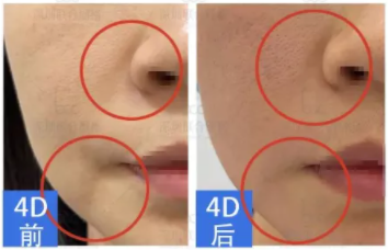 同属抗衰激光,fotona4d与5gmax怎么选?