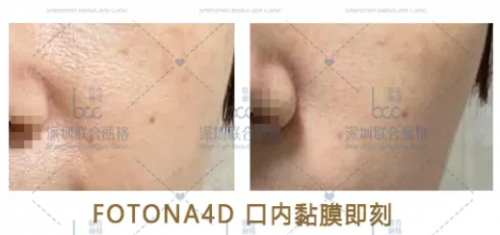 同属抗衰激光,fotona4d与5gmax怎么选?