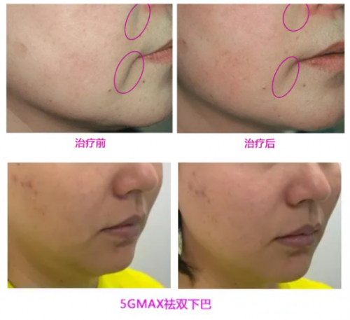 同属抗衰激光,fotona4d与5gmax怎么选?