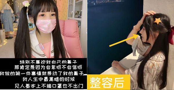 蔡萝莉整容失败 认了动刀失败很自卑