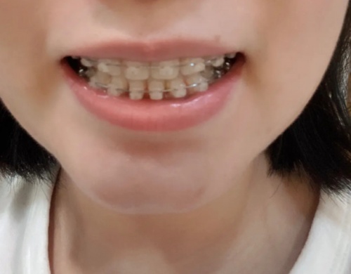 一文读懂：思娇丽恒负压非手术隆胸系统