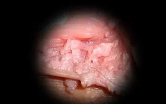 hpv有什么表现症状女性照片图 真实女性早期hpv感染图片 hpv有什么表现症状女性照片图 真实女性早期hpv感染图片