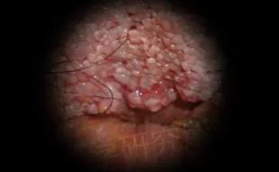 hpv有什么表现症状女性照片图 真实女性早期hpv感染图片 hpv有什么表现症状女性照片图 真实女性早期hpv感染图片