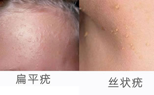 hpv有什么表现症状女性照片图 真实女性早期hpv感染图片 hpv有什么表现症状女性照片图 真实女性早期hpv感染图片