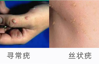 hpv有什么表现症状女性照片图 真实女性早期hpv感染图片 hpv有什么表现症状女性照片图 真实女性早期hpv感染图片