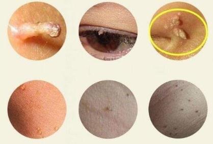 hpv有什么表现症状女性照片图 真实女性早期hpv感染图片 hpv有什么表现症状女性照片图 真实女性早期hpv感染图片