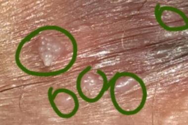 hpv有什么表现症状女性照片图 真实女性早期hpv感染图片 hpv有什么表现症状女性照片图 真实女性早期hpv感染图片