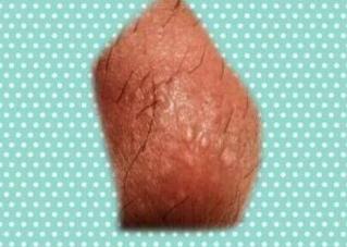 hpv有什么表现症状女性照片图 真实女性早期hpv感染图片 hpv有什么表现症状女性照片图 真实女性早期hpv感染图片