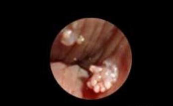 hpv有什么表现症状女性照片图 真实女性早期hpv感染图片 hpv有什么表现症状女性照片图 真实女性早期hpv感染图片