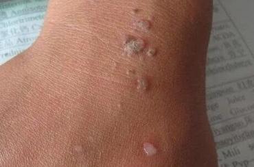 hpv有什么表现症状女性照片图 真实女性早期hpv感染图片 hpv有什么表现症状女性照片图 真实女性早期hpv感染图片