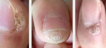 hpv有什么表现症状女性照片图 真实女性早期hpv感染图片 hpv有什么表现症状女性照片图 真实女性早期hpv感染图片