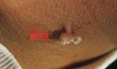 hpv有什么表现症状女性照片图 真实女性早期hpv感染图片 hpv有什么表现症状女性照片图 真实女性早期hpv感染图片