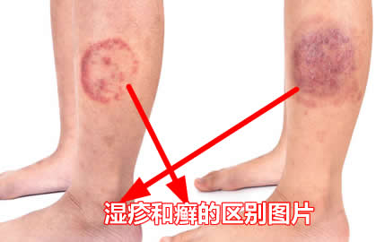 湿疹和癣的区别图片(区分图对比)