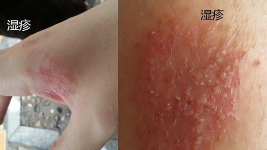 湿疹和癣的区别图片(区分图对比)