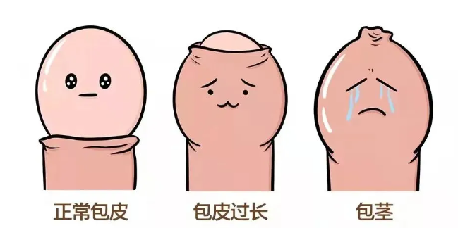 到底啥样的包皮需要割？出现这几种情况时...