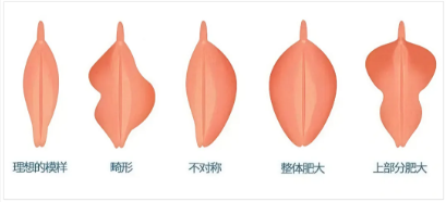 阴唇一边大一边小是正常的吗