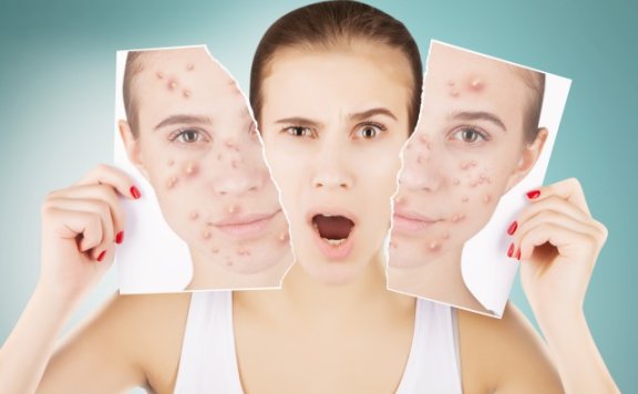 红色痘印怎么消除最快,分享快速去痘印最有效的方法