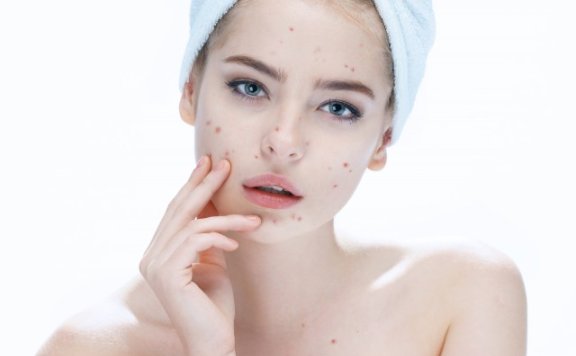 额头痘印怎么最快淡化,教你祛痘印有效的方法