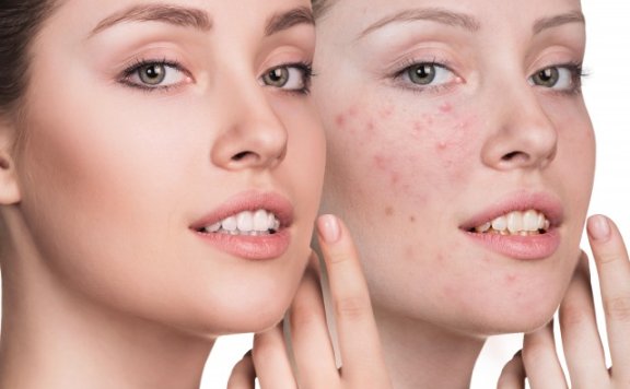 闭合性粉刺怎么排出来,这4点需要注意
